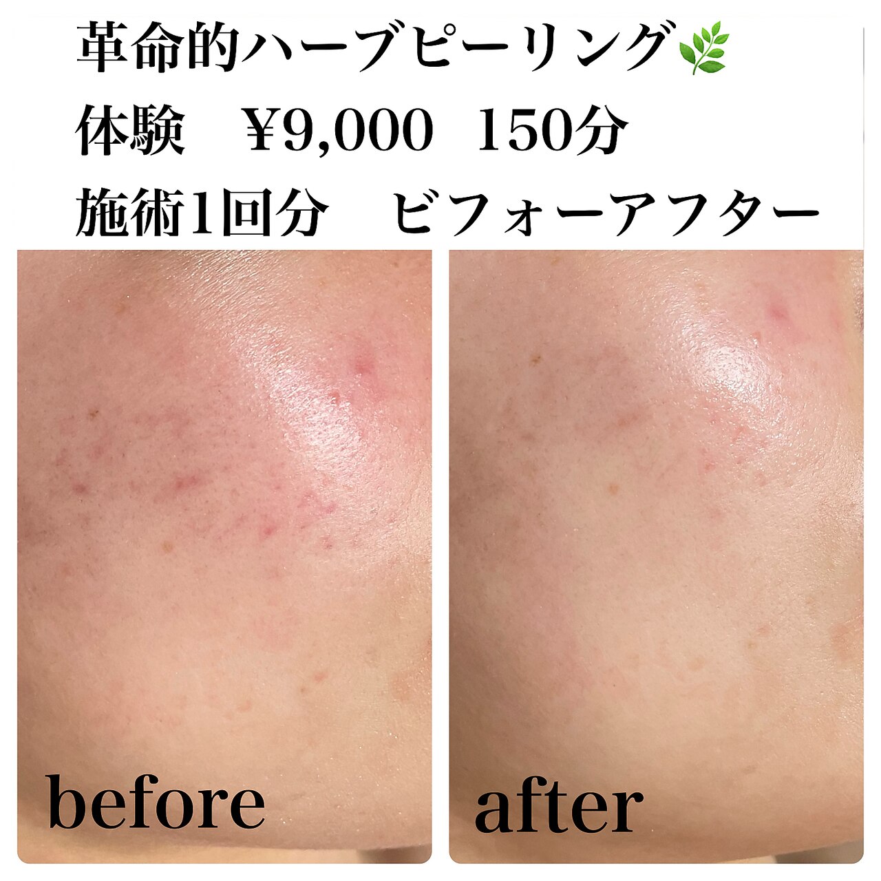 トリートメント追加